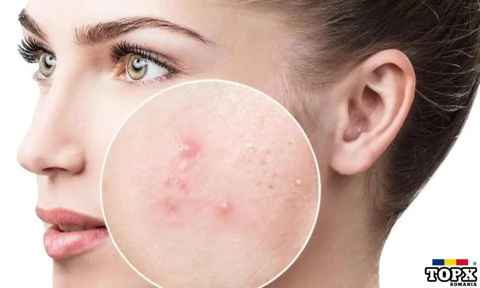 Ai acnee facială și vrei ajutor REAL + bani?