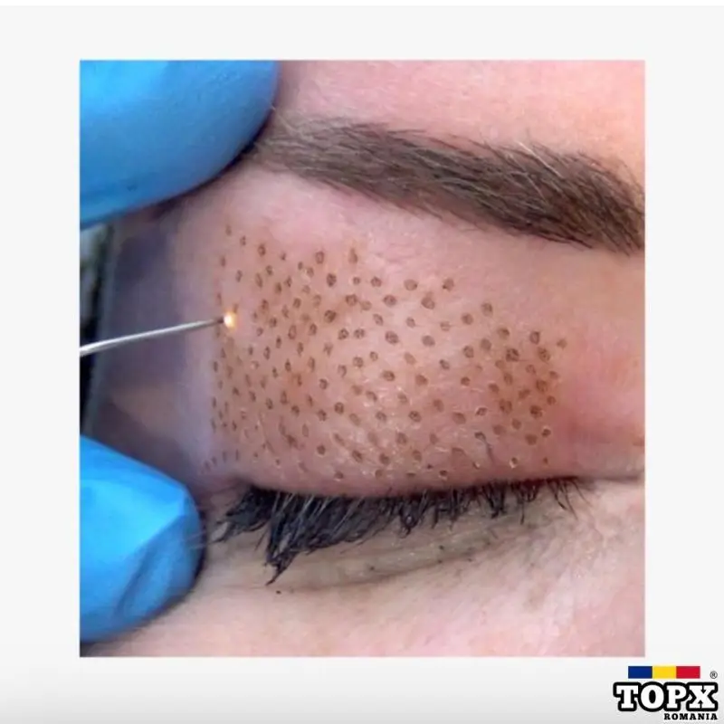 Plasma Pen/ Tatuaj buze/ Tatuaj sprancene/ Marire buze/ Mezoterapie - sector 5